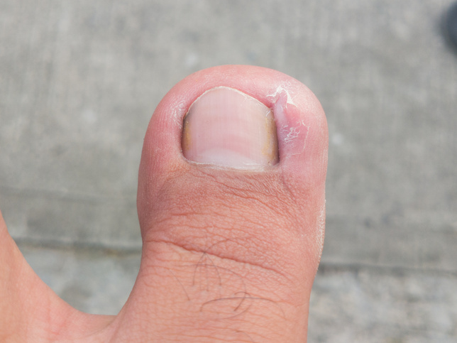 Dirty toenails can cause a foul smell and ingrown toenails